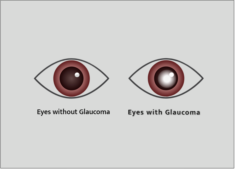 Glaucoma Detection